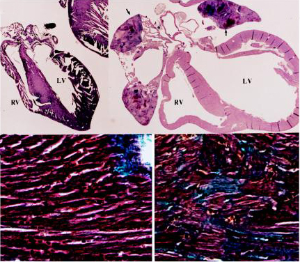 Characteristics of peripartum cardiomyopathy in Gαq-overexpressing mice. (Top) Gross morphology (4×) of peripartum nontransgenic (Left) and Gαq-overexpressing (Right) mouse hearts showing cardiomyopathic dilatation of cardiac chambers (LV, left ventricle; RV, right ventricle) with mural thrombi in atria (arrows). (Bottom) Trichrome stain (400×) of hearts depicted inb shows interstitial fibrosis and myocyte replacement (blue-stained cells), without inflammation in transgenic heart (Right).