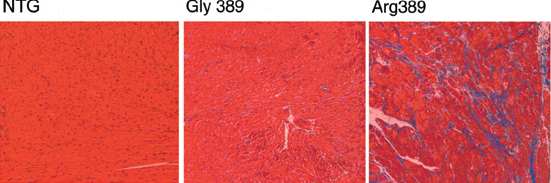 Allele-specific features of Arg389 and Gly389 β1-AR in transgenic mice and human heart failure. Histopathologic sections of 9-month-old mice showed no abnormalities in nontransgenic (NTG) or Gly389 hearts, whereas Arg389 ventricles had extensive myocyte loss and fibrosis. 