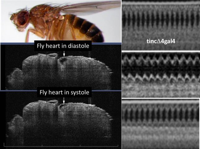 Optical coherence tomography imaging of functioning heart tubes in intact, unanesthetized fruit flies using a Michelson Diagnostics 1300 nm multi-beam EX1301 OCT microscope (greater than 10 um resolution). Two-dimensional images (left panels) are post-processed to achieve b-mode tracings analogous to mouse/human m-mode echocardiography studies (right panels). Top right tracing is normal control (tincD4gal4) heart. Middle right tracing is dilated hypocontractile cardiomyopathic heart that was rescued genetically (bottom tracing).